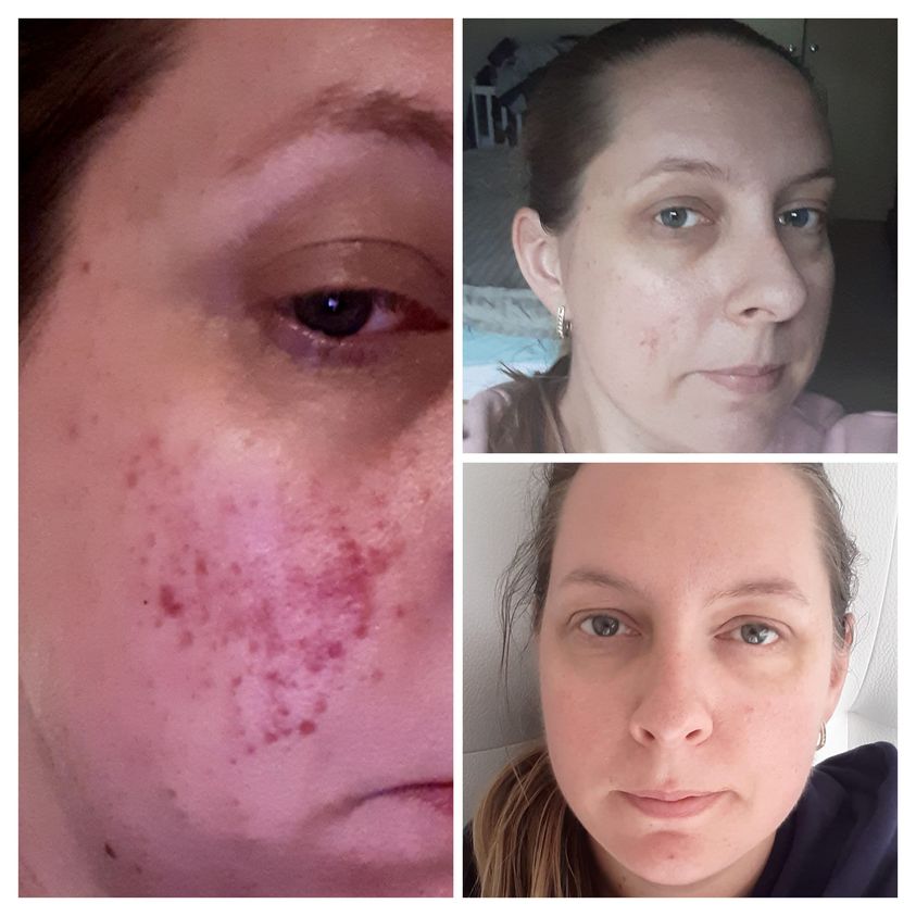 Belinda_Magro_skincare_before_and_after_pre_clease_blemish_cleanser_waffle_cloth_night_cream_night_oil